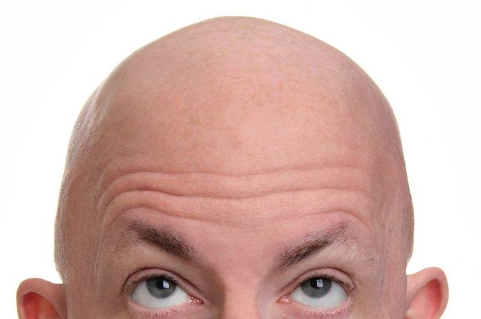 All About Follicular Unit Extraction (FUE) Hair Transplant